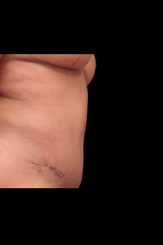 Abdominoplasty (Tummy Tuck) Before & After Patient #675