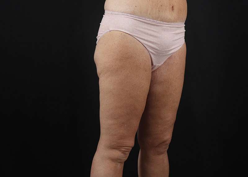 Thigh Lift Before & After Patient #1818