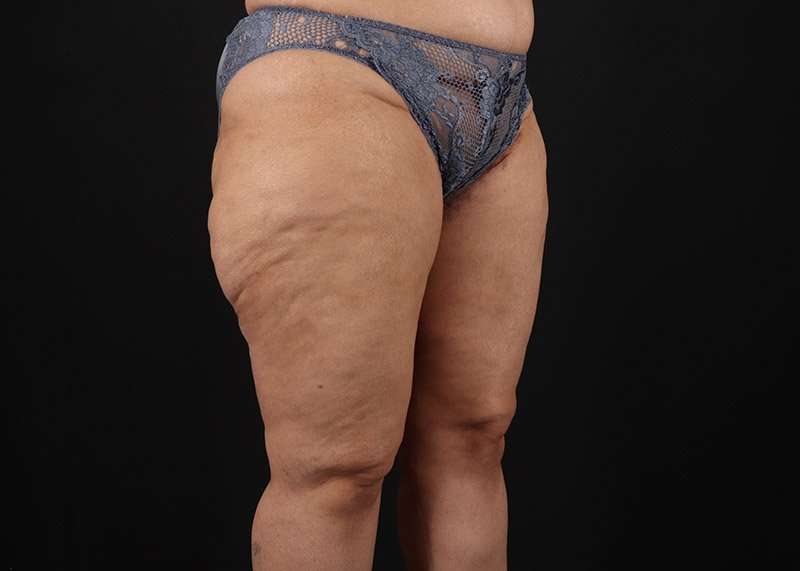 Thigh Lift Before & After Patient #1831