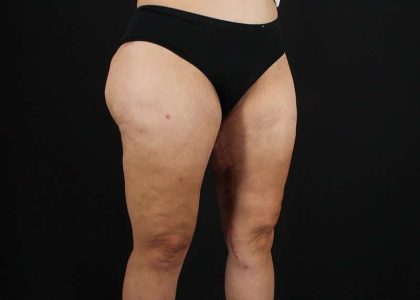 Thigh Lift Before & After Patient #1844