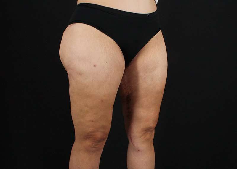 Thigh Lift Before & After Patient #1844
