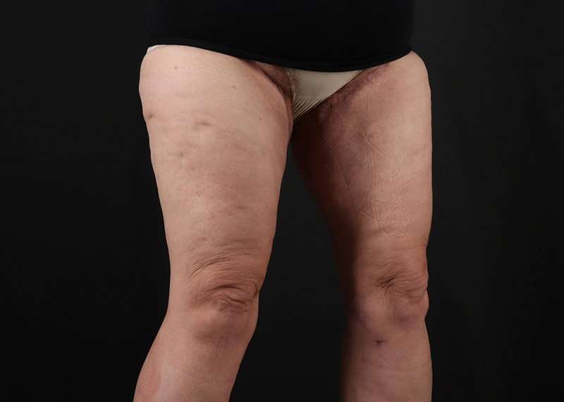 Thigh Lift Before & After Patient #1857
