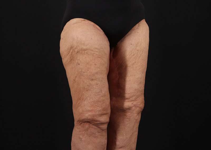 Thigh Lift Before & After Patient #1871