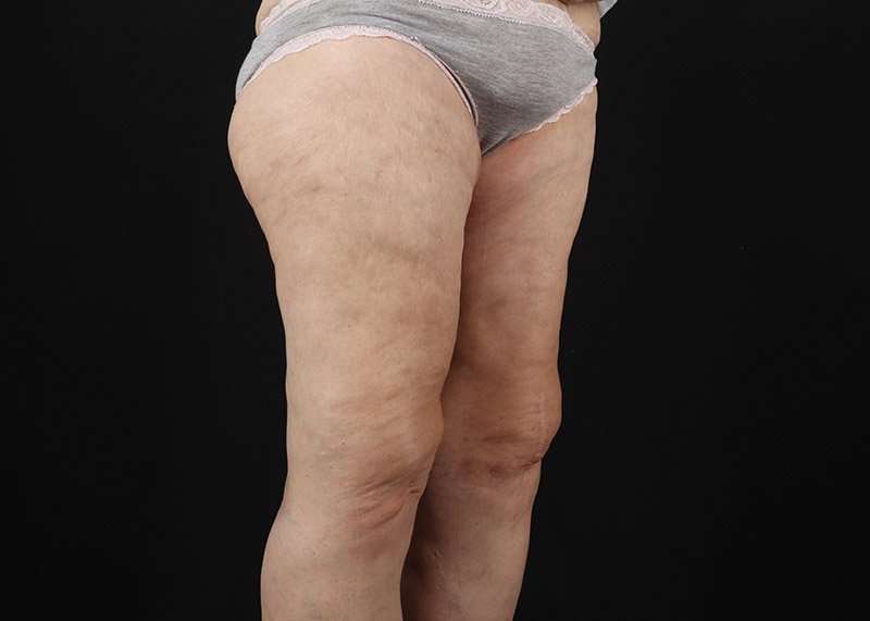 Thigh Lift Before & After Patient #1884