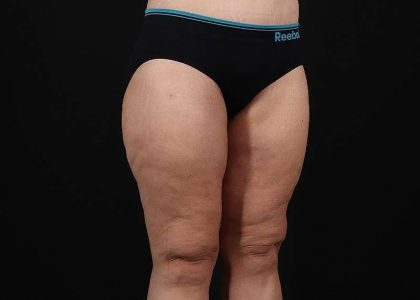 Thigh Lift Before & After Patient #1897