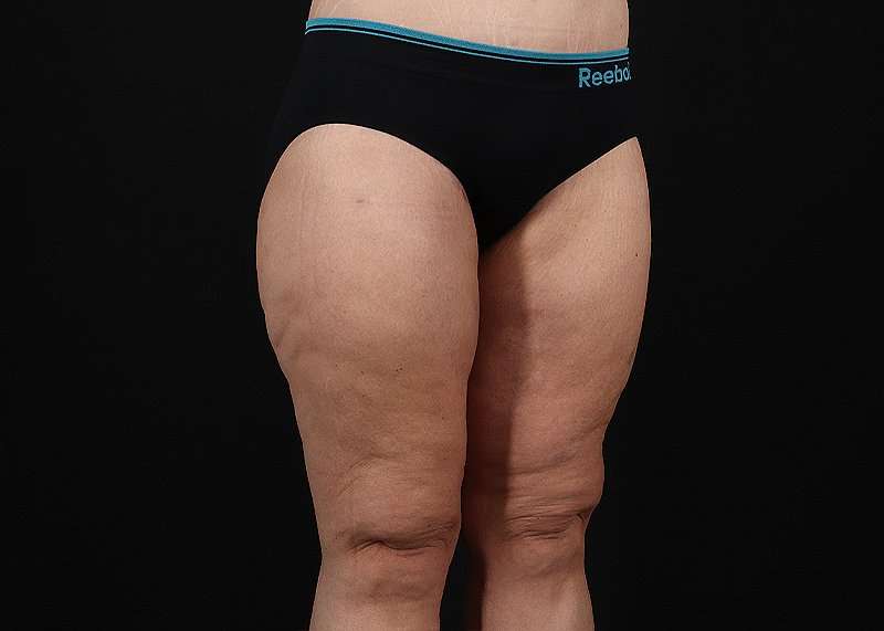 Thigh Lift Before & After Patient #1897