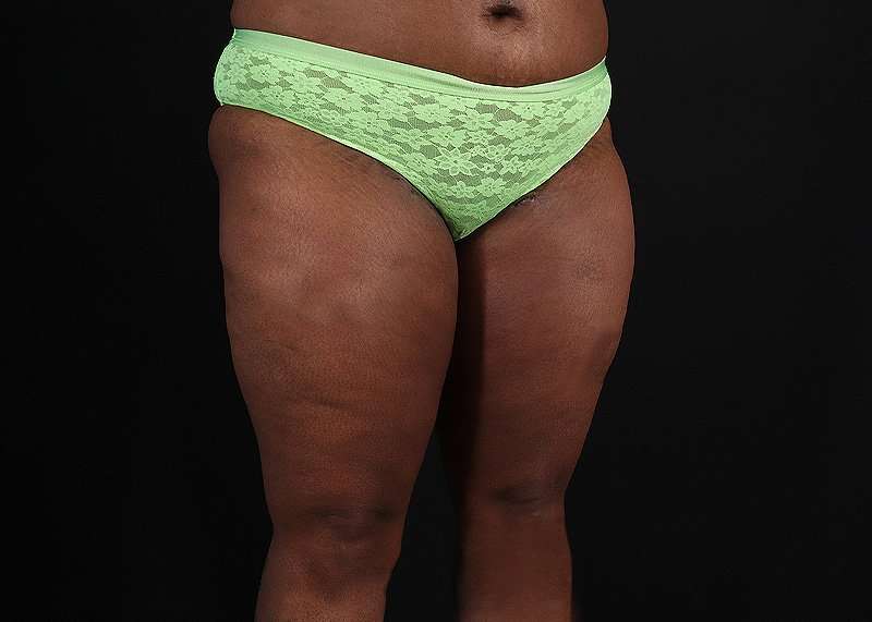 Thigh Lift Before & After Patient #1911