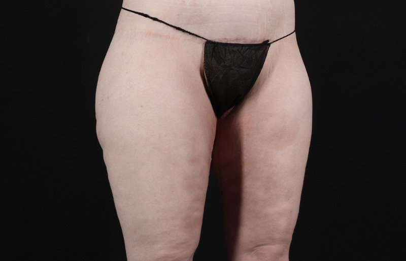 Thigh Lift Before & After Patient #1925