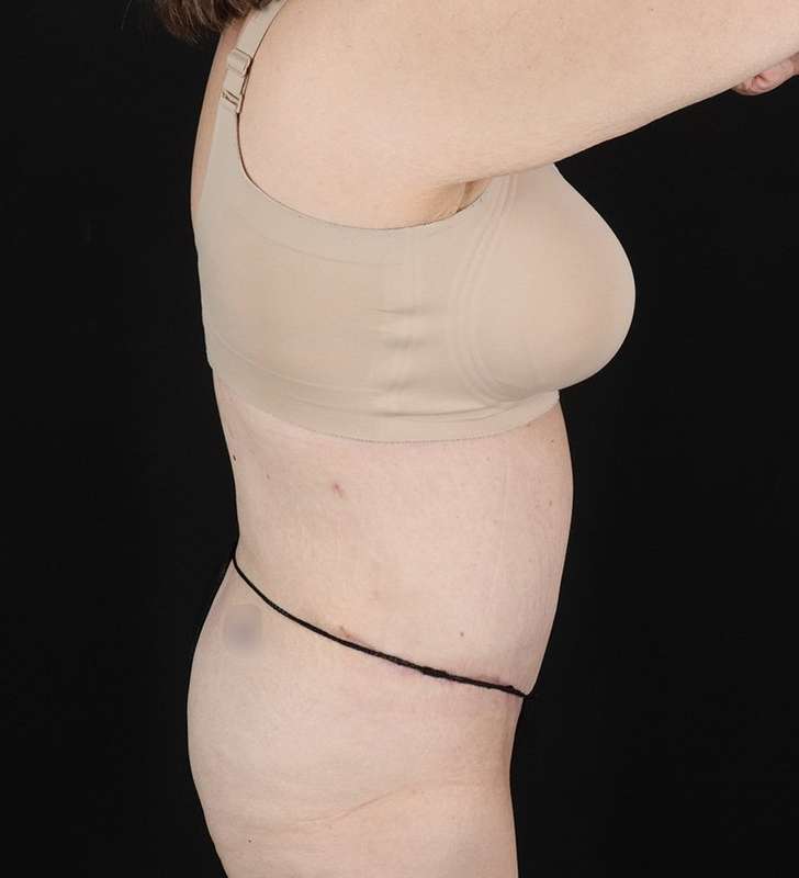 Back Lift/Tuck Before & After Patient #1939