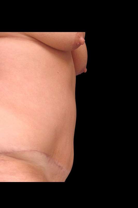 Abdominoplasty (Tummy Tuck) Before & After Patient #680