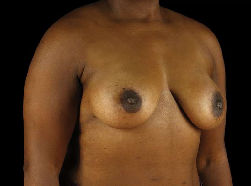 Breast Augmentation Before & After Patient #2121