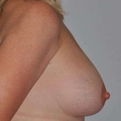Breast Augmentation Before & After Patient #2286