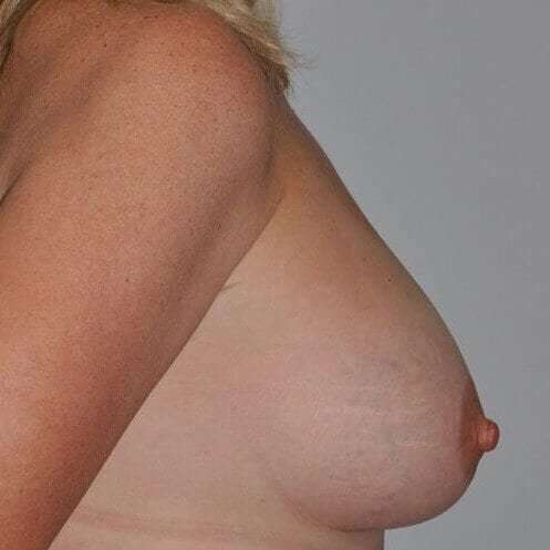 Breast Augmentation Before & After Patient #2286