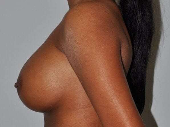 Breast Augmentation Before & After Patient #2291