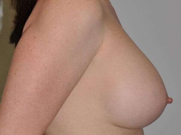 Breast Augmentation Before & After Patient #2297