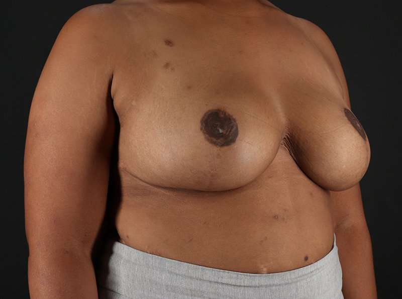 Breast Reduction Before & After Patient #2463