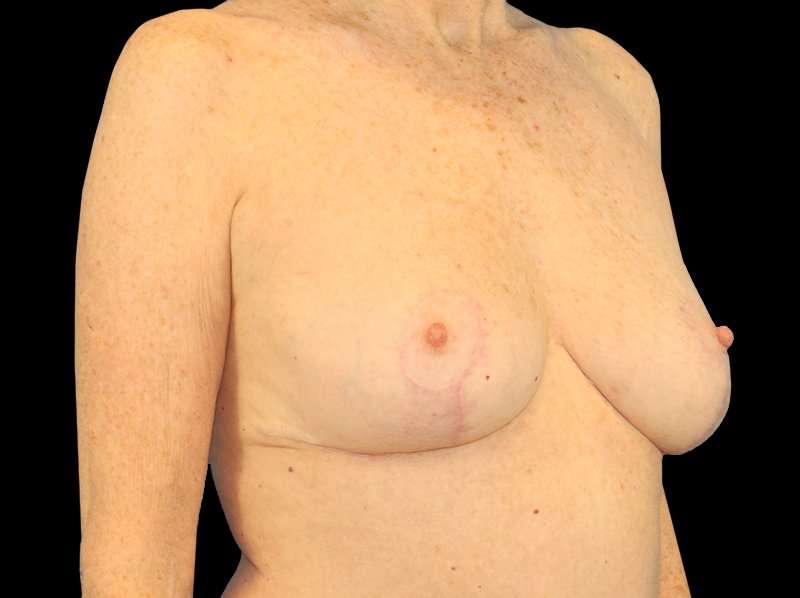 Breast Reduction Before & After Patient #2474