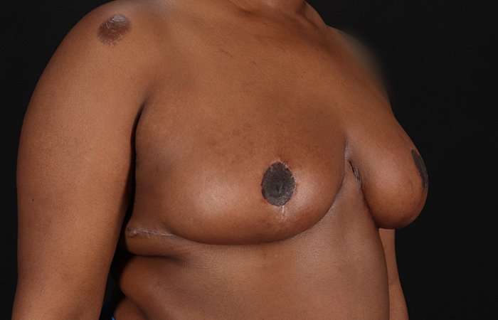 Breast Reduction Before & After Patient #2487