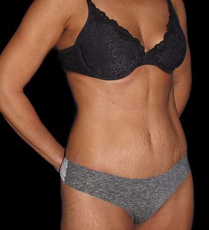 Abdominoplasty (Tummy Tuck) Before & After Patient #757