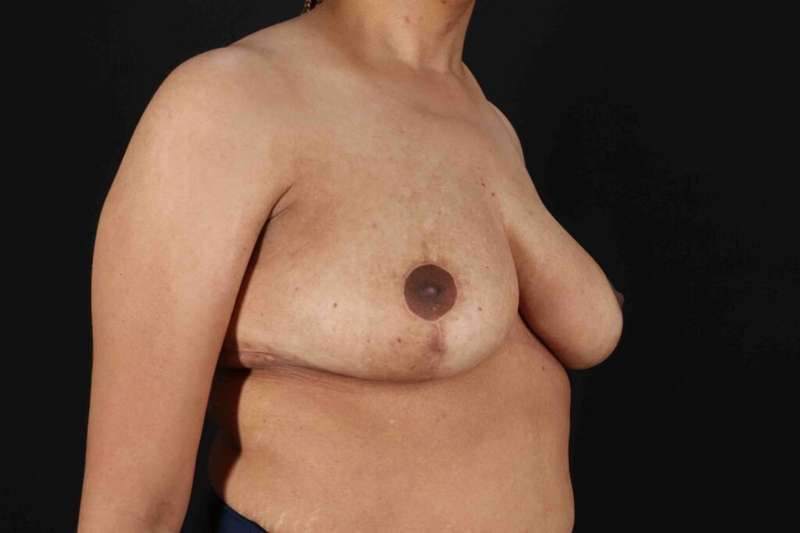 Breast Reduction Before & After Patient #2509