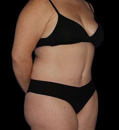 Abdominoplasty (Tummy Tuck) Before & After Patient #768