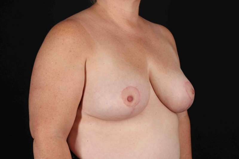 Breast Reduction Before & After Patient #2613