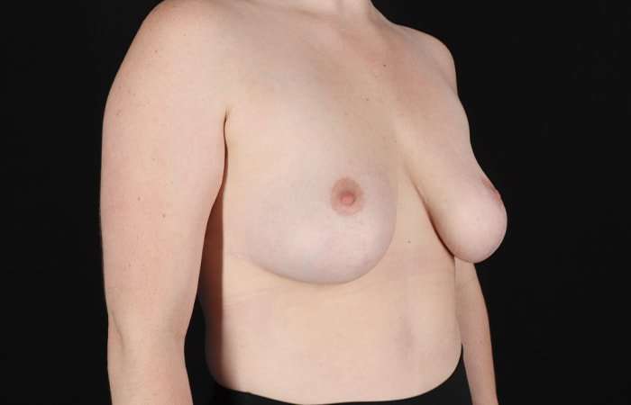 Breast Reduction Before & After Patient #2624