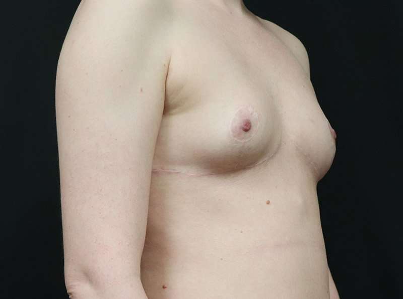 Breast Reduction Before & After Patient #2635