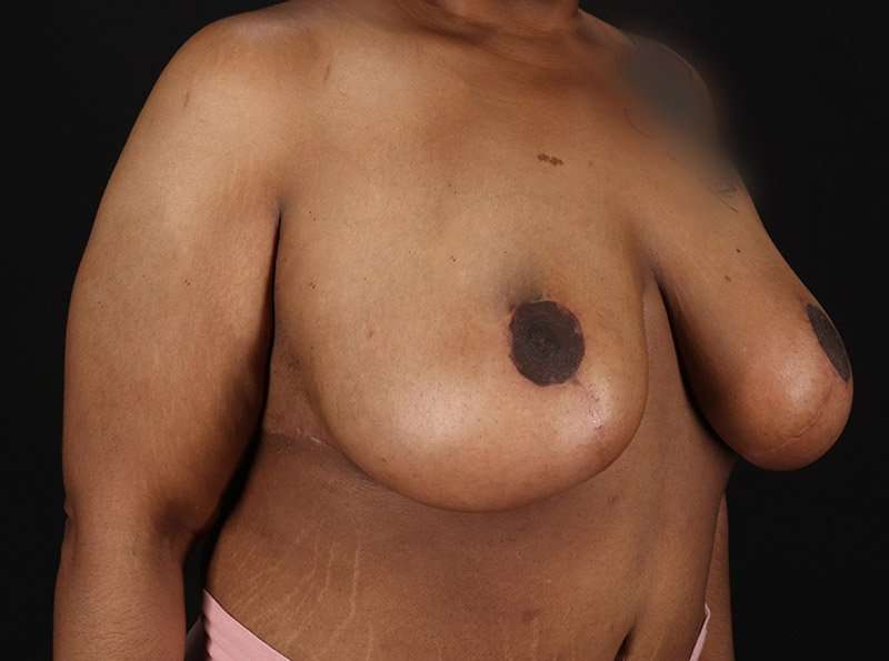 Breast Reduction Before & After Patient #2646