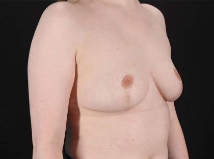 Breast Reduction Before & After Patient #2693