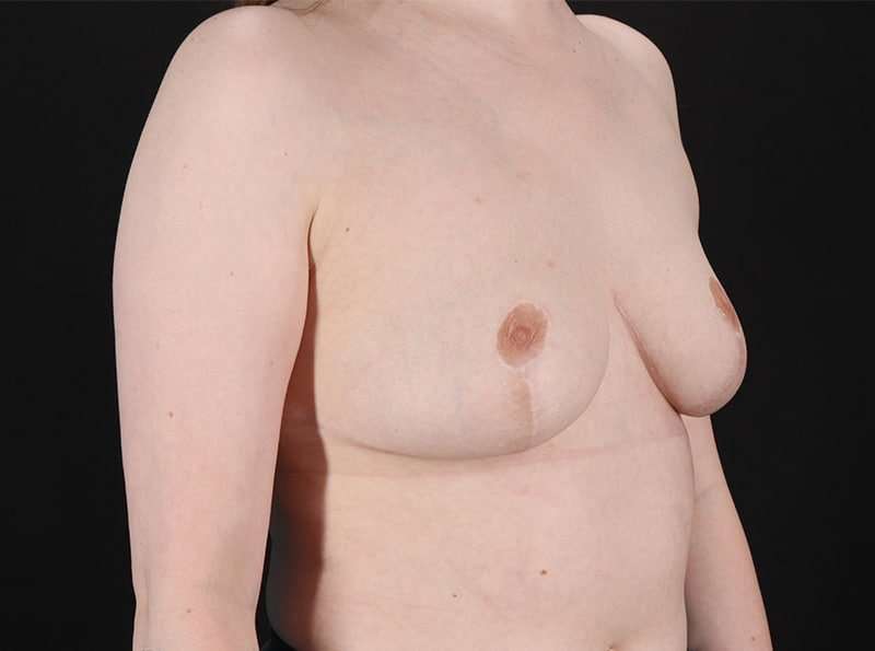 Breast Reduction Before & After Patient #2693