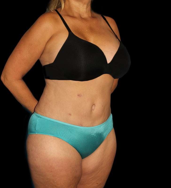 Abdominoplasty (Tummy Tuck) Before & After Patient #579