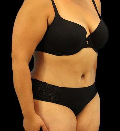 Abdominoplasty (Tummy Tuck) Before & After Patient #779