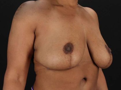 Breast Reduction Before & After Patient #2777