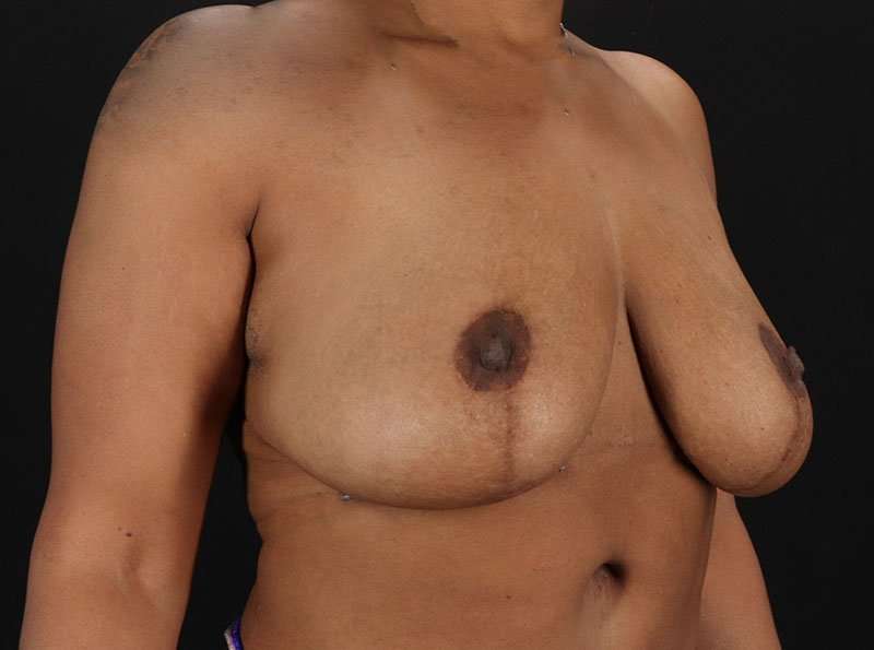 Breast Reduction Before & After Patient #2777