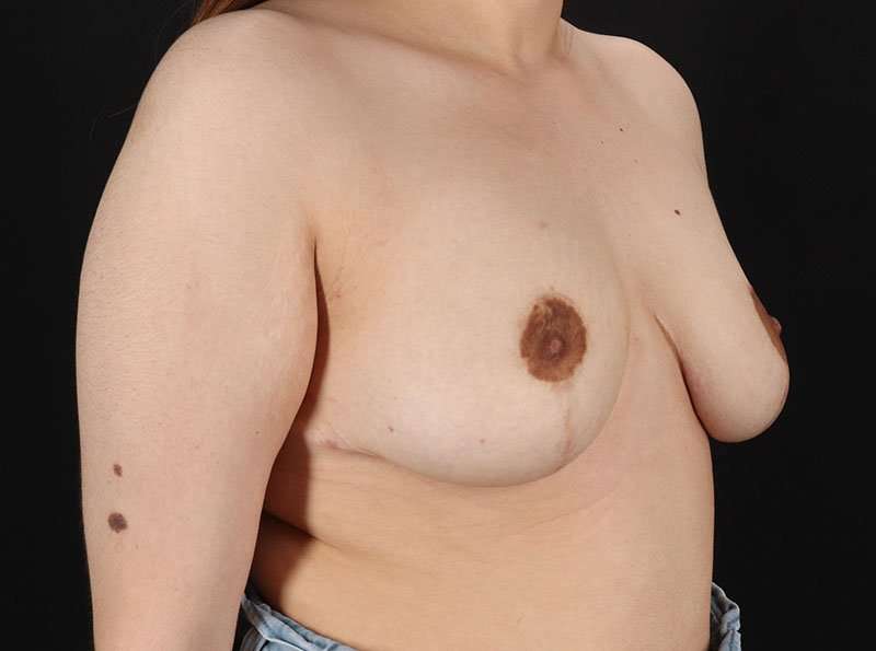 Breast Reduction Before & After Patient #2788