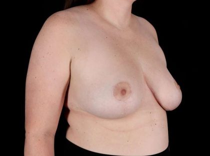 Breast Reduction Before & After Patient #2802