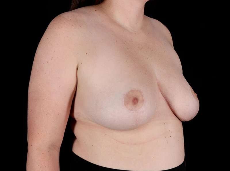 Breast Reduction Before & After Patient #2802