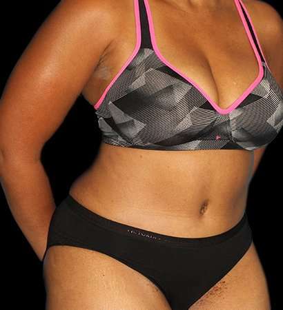 Abdominoplasty (Tummy Tuck) Before & After Patient #790