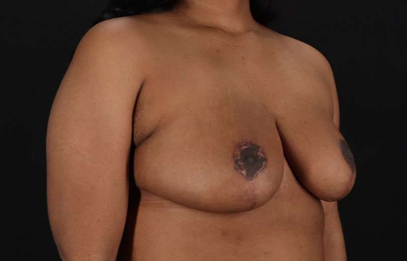 Breast Reduction Before & After Patient #2824