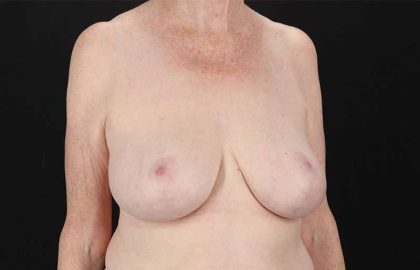 Breast Reduction Before & After Patient #2836