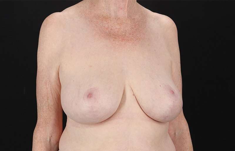 Breast Reduction Before & After Patient #2836