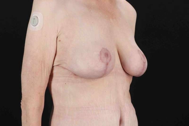 Breast Reduction Before & After Patient #2847