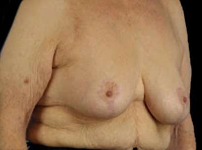 Breast Reduction Before & After Patient #2859
