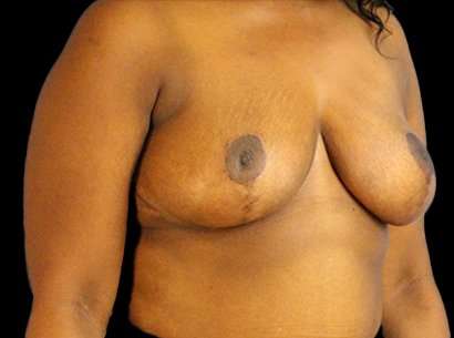 Breast Reduction Before & After Patient #2870