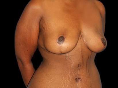 Breast Reduction Before & After Patient #2881