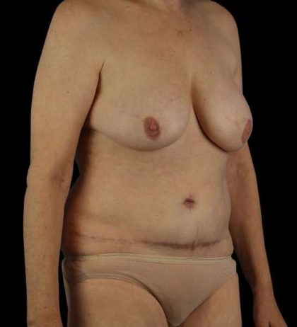 DIEP Flap Before & After Patient #2943