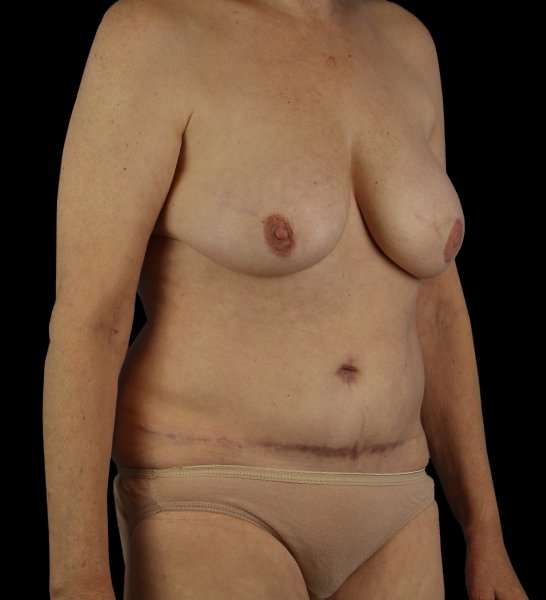 DIEP Flap Before & After Patient #2943