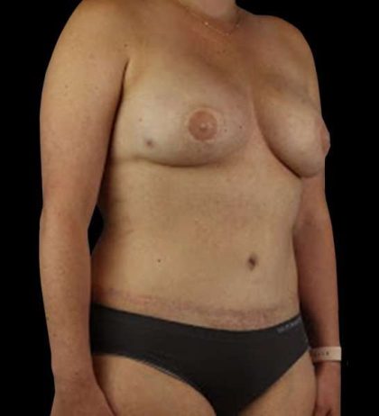 DIEP Flap Before & After Patient #2954