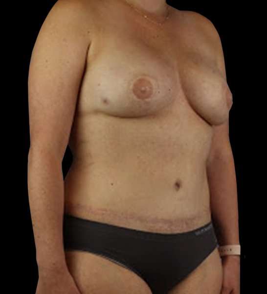 DIEP Flap Before & After Patient #2954